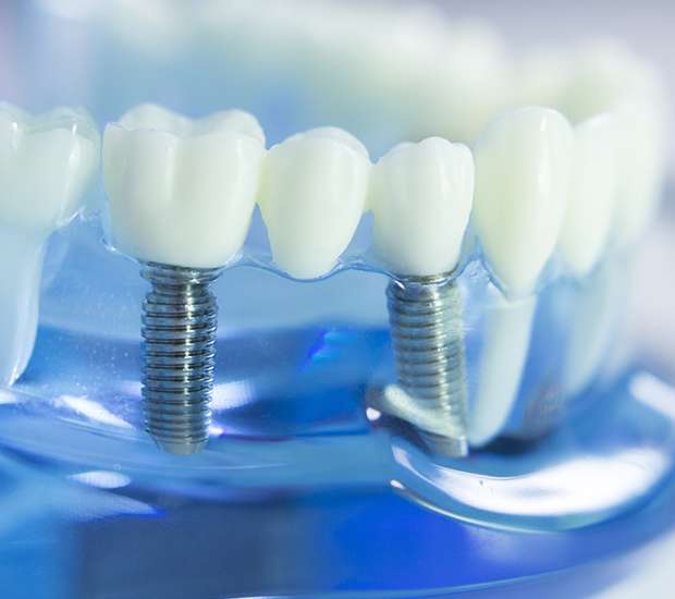 Miramar Dental Implants